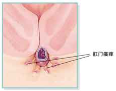 肛门瘙痒