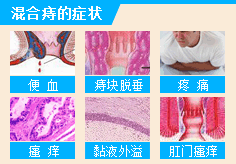 混合痔的症状