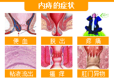 内痔的症状