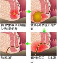 肛周脓肿